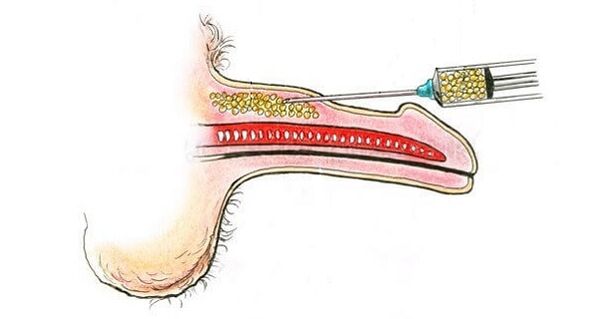 Injections d'acide hyaluronique dans le canon d'un membre afin de l'augmenter